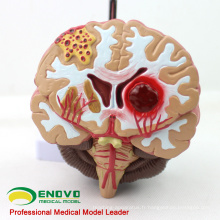 BRAIN10 (12408) Modèle anatomique médical de la maladie du cerveau, modèle anatomique de la malformation de l&#39;artère cérébrale